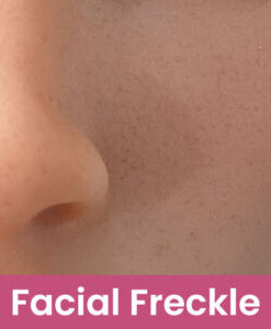 SEDoll-Other Options-Facial Freckle