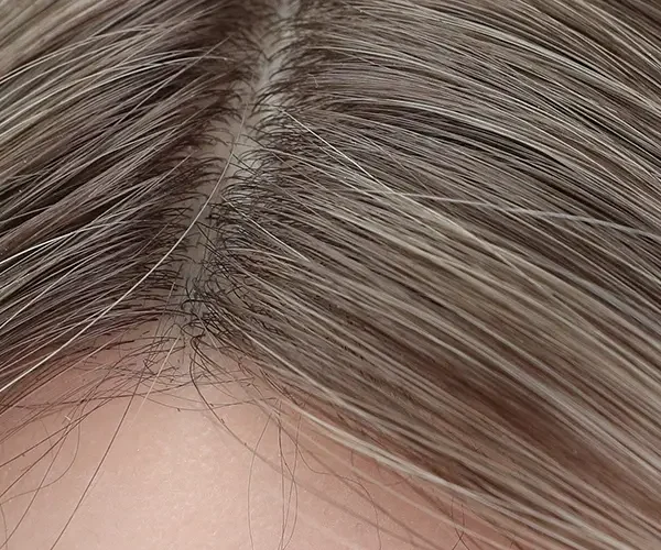 Implanted Human Hair