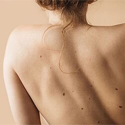Body Moles